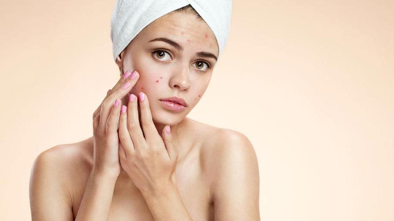 Benarkah Darah Haid Bisa Hilangkan Jerawat?