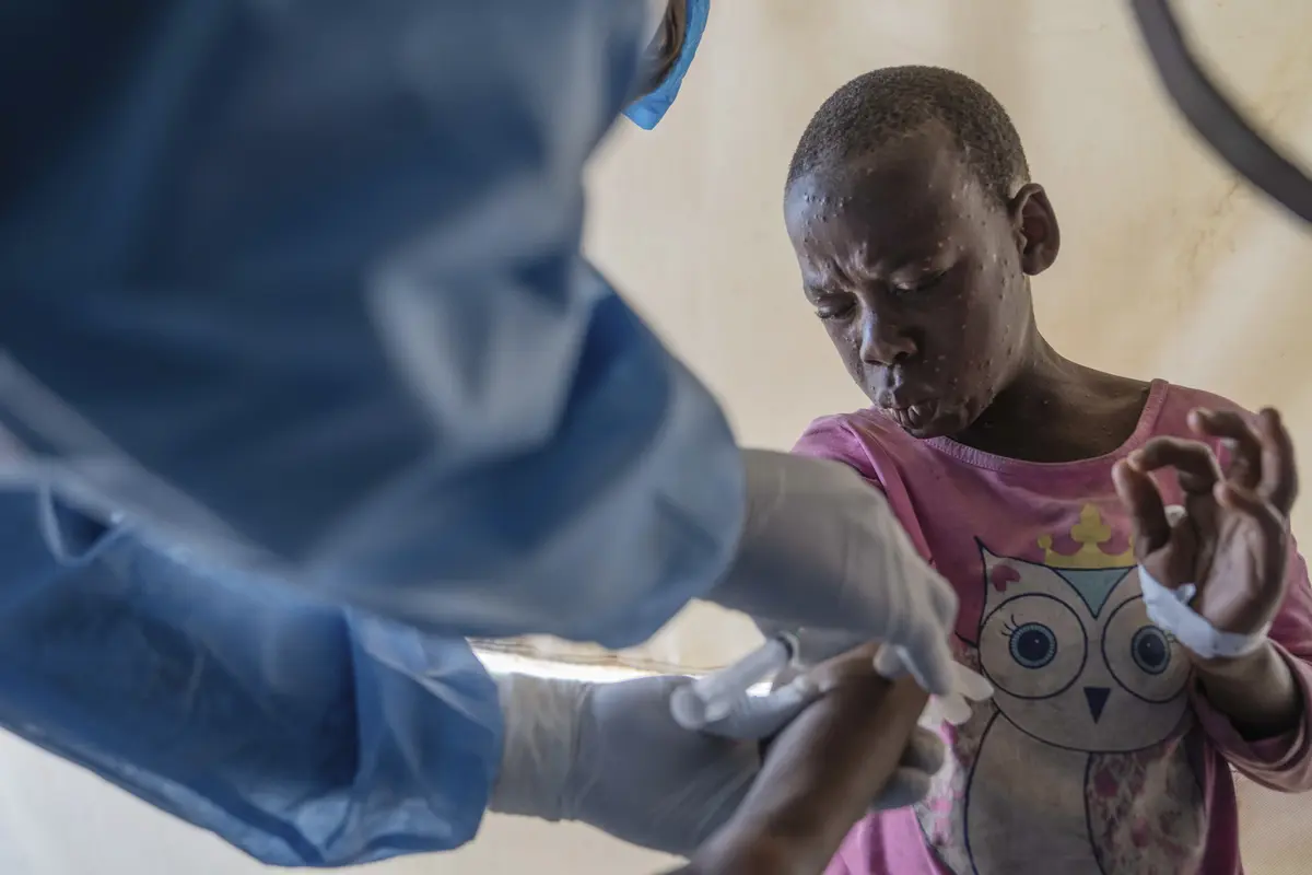 Kongo akan menerima vaksin mpox pertama