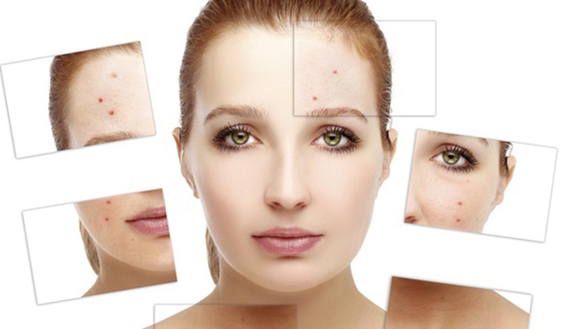 Nggak Mau Jerawatan? Kurangi Konsumsi 8 Jenis Makanan Ini - Beauty