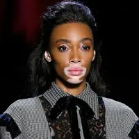 Dukungan positif dibutuhkan karena pengidap Vitiligo rentan terhadap stres, kecemasan, hingga depresi akibat mendapat stigma tertentu. (Foto: Instagram.com/Winnie Harlow).