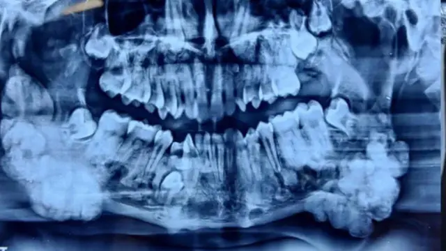 Derita Tumor Langka, Pria Ini Miliki 82 Gigi dalam Mulutnya