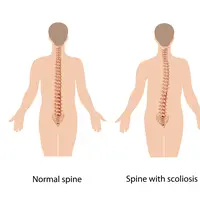 Skoliosis (via healthcaresolutionsplus.org)