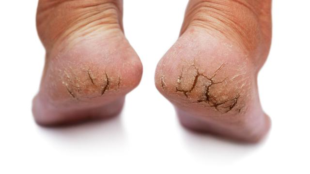 Cara Mudah Mengatasi Kulit Kering Pada Kaki