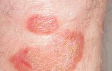 Mengenal Psoriasis Vulgaris: Pemicu, Penyebab, Gejala, dan Dampak Negatifnya