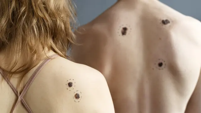 Seorang laki-laki dan perempuan dengan bercak pada kulit punggungnya (Foto Dok: Freepik/freepik)