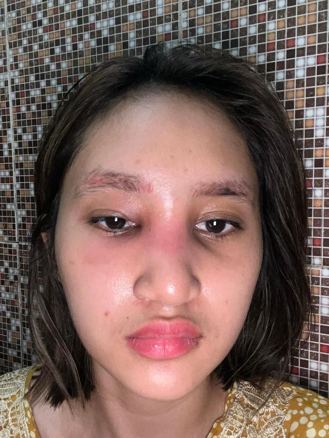 Sempat Oplas, Ini 6 Potret Permesta Dhyaz Anak Farida Nurhan Alami Infeksi Implan