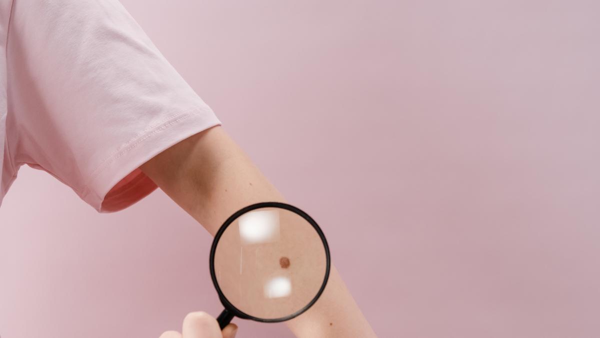 Tahi Lalat di Tangan hingga Kaki, Benarkah Bisa Ungkap Sifat Aslimu?