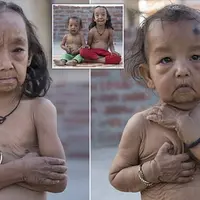 Ketika kondisi karakter Benjamin Button benar-benar ada di dunia nyata.