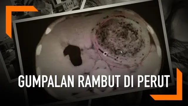 VIDEO: Gumpalan Rambut 1,5 Kg Ditemukan di Perut Bocah