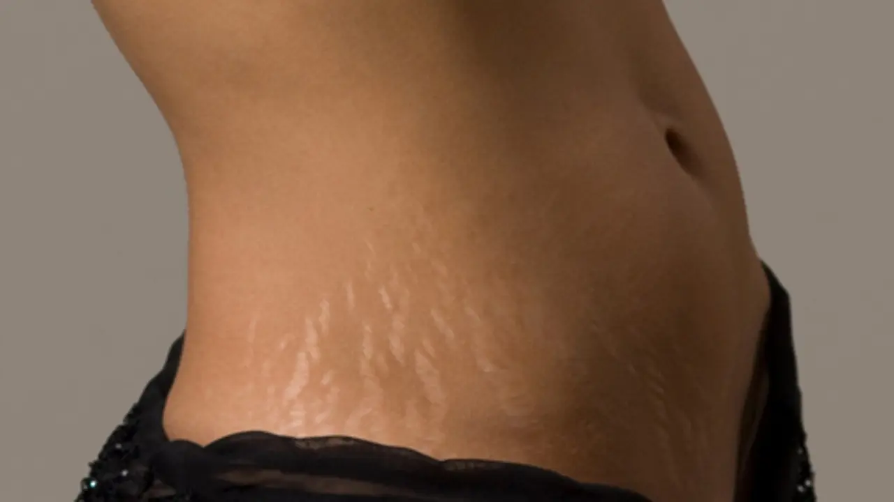 Ketahui 5 Fakta Tentang Strech Mark
