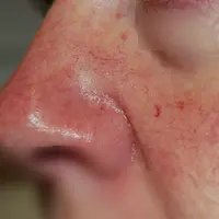 Urat halus di pipi | Sumber Foto: dermamagz