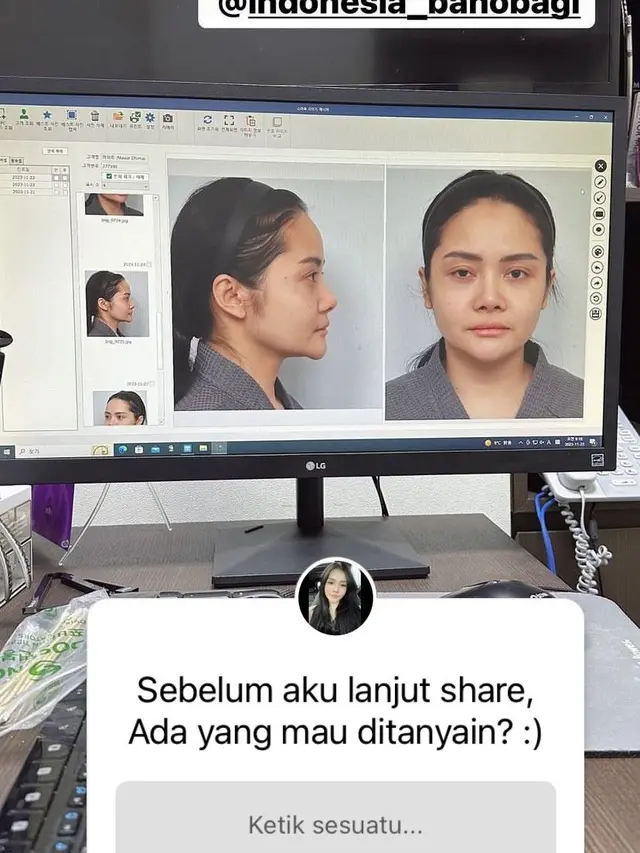 Mawar AFI Oplas Hidun di Korea Korea Selatan