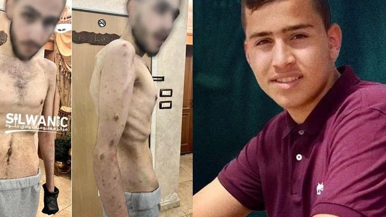 Kondisi Miris Tawanan Palestina yang Dibebaskan Israel 'Tinggal' Tulang & Penuh Kudis