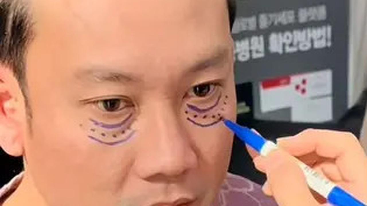 Dibujuk Istri, Denny Sumargo Jalani Prosedur Operasi Kantong Mata di Korea Selatan