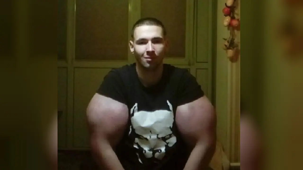 Demi mendapatkan ukuran lengan yang berdiameter besar seperti karakter Hulk, Tereshin nekat menyuntikkan Synthol ke kedua lengannya (Instagram/@slac_ker_)