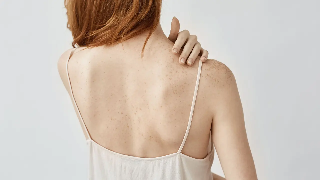 back acne