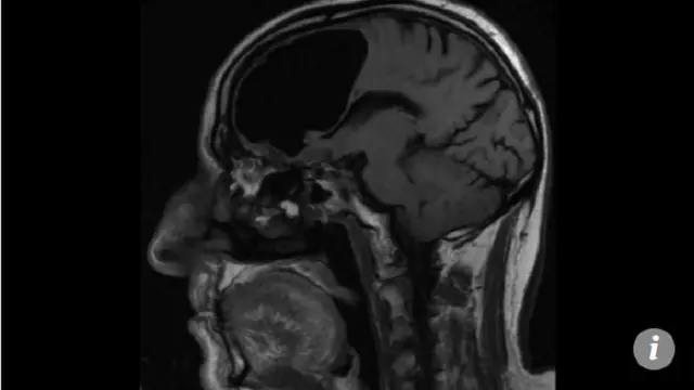 Bagian Kiri Otak Pasien Hilang, Dokter di Irlandia Kebingungan