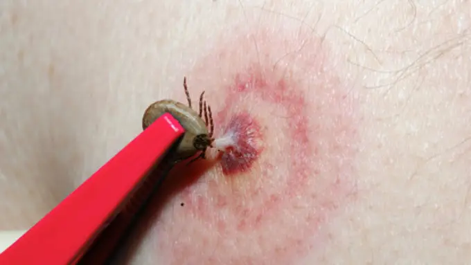 Sakit Kepala Hebat Bisa Jadi Gejala Penyakit Lyme, Apakah Itu?