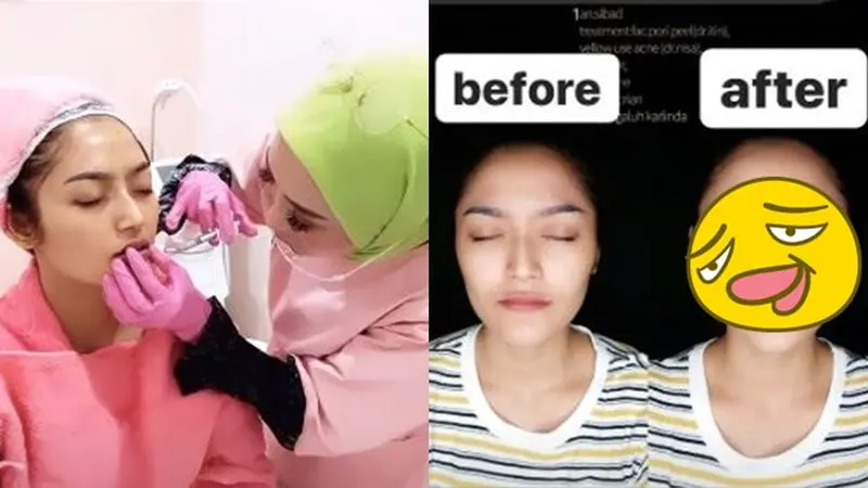 6 Potret Terbaru Siti Badriah Setelah Filler Bibir, Makin Seksi