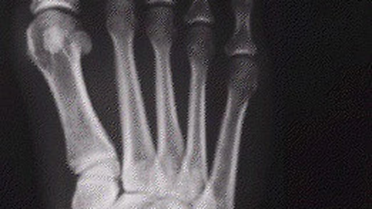 bunion