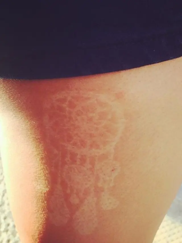 Sunburn Tattoo/Art
