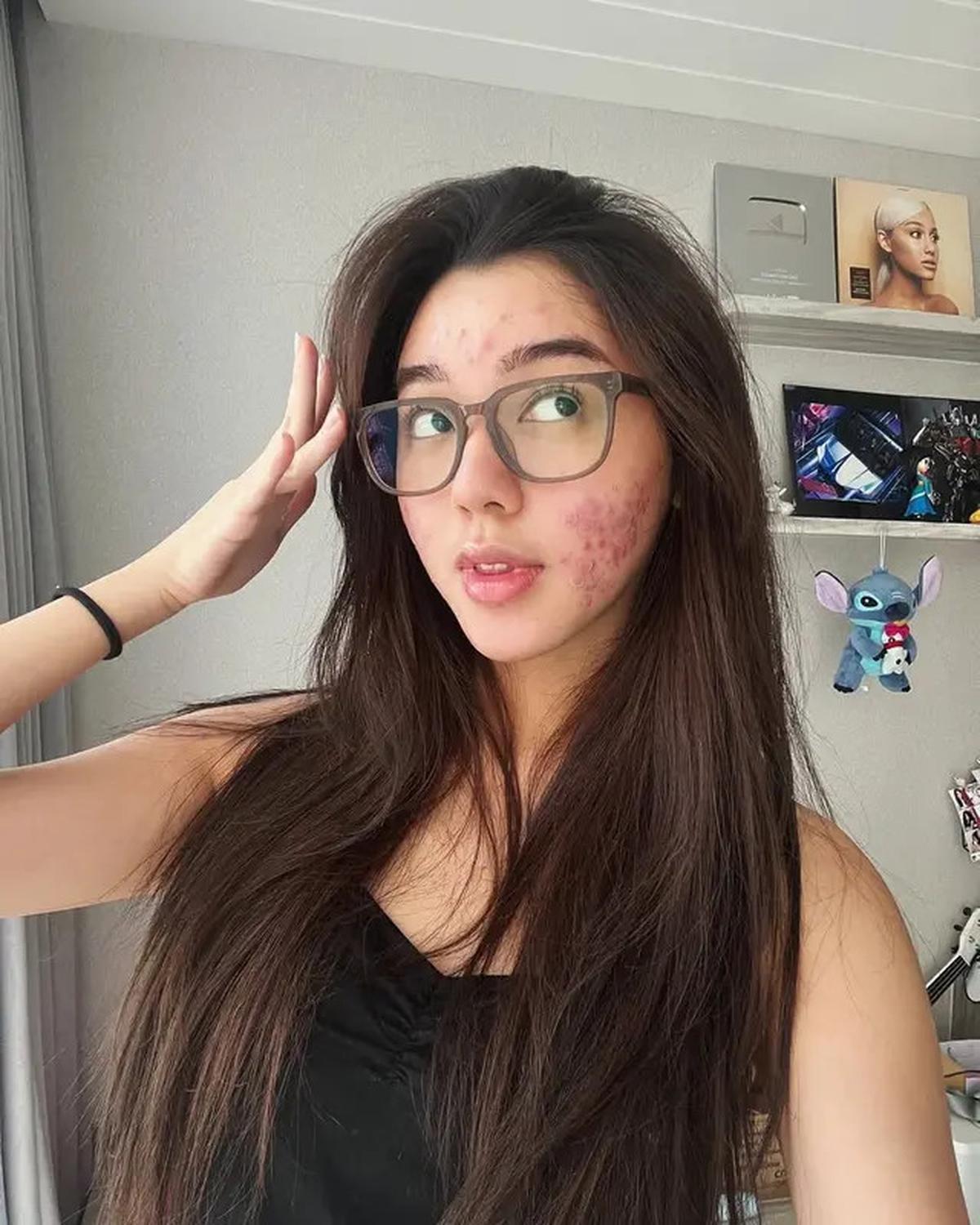 6 Potret Wajah Gabriella Ekaputri Berjerawat, Tetap Percaya Diri Tampil Natural