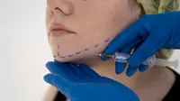 Fat Transfer Manfaatkan Lemak Sendiri dalam Prosedur Estetik, Lebih Aman Ketimbang Filler Sintetis