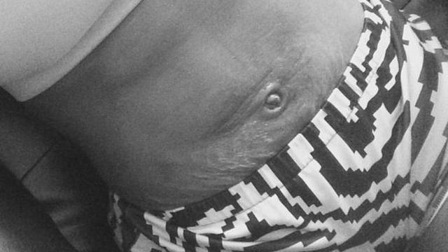 Apa Penyebab Stretch Mark Dan Cara Mengatasinya Health Liputan6 Com