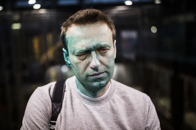 Wajah Alexei Navalny pasca-disiram air keras pada Kamis 27 April 2017 (Evgeny Feldman/AP)