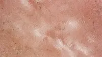 Stevens Johnson Syndrome Bisa Dipicu Obat, Ketahui Ciri dan Cara Penanganannya