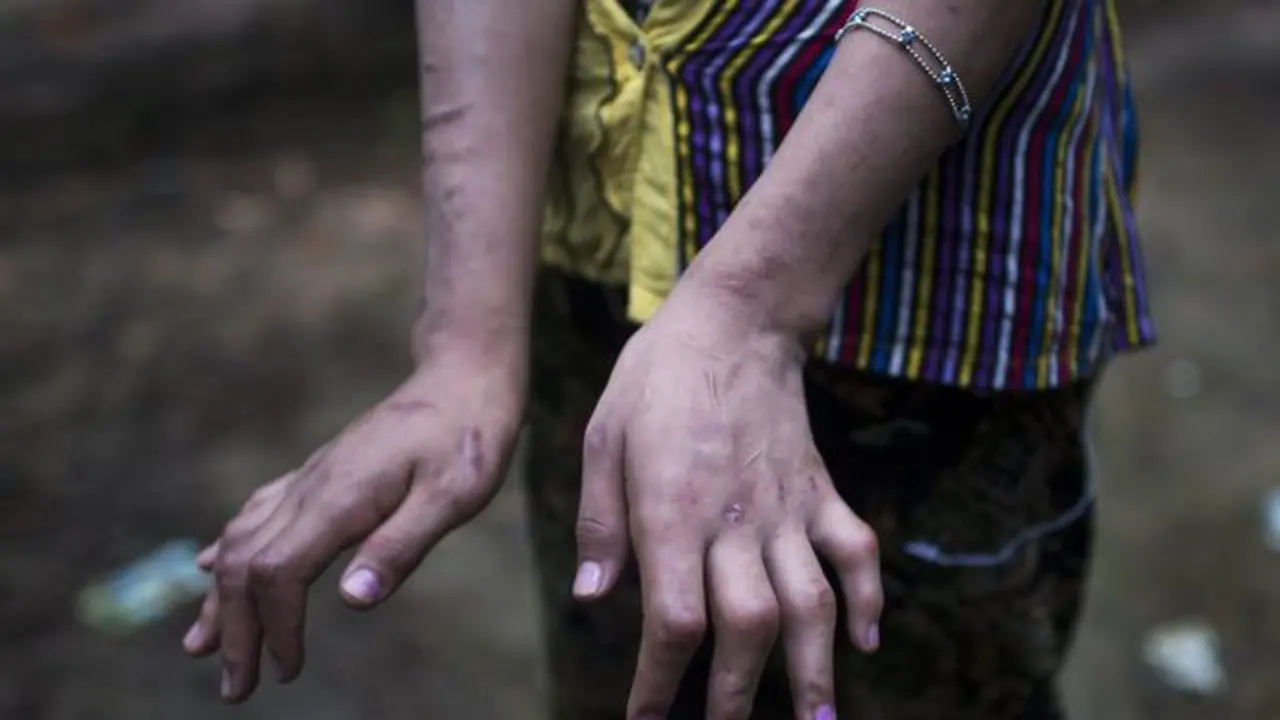 Remaja perempuan ini diduga disiksa hingga kedua jari tangannya memiliki luka bakar dan bengkok
