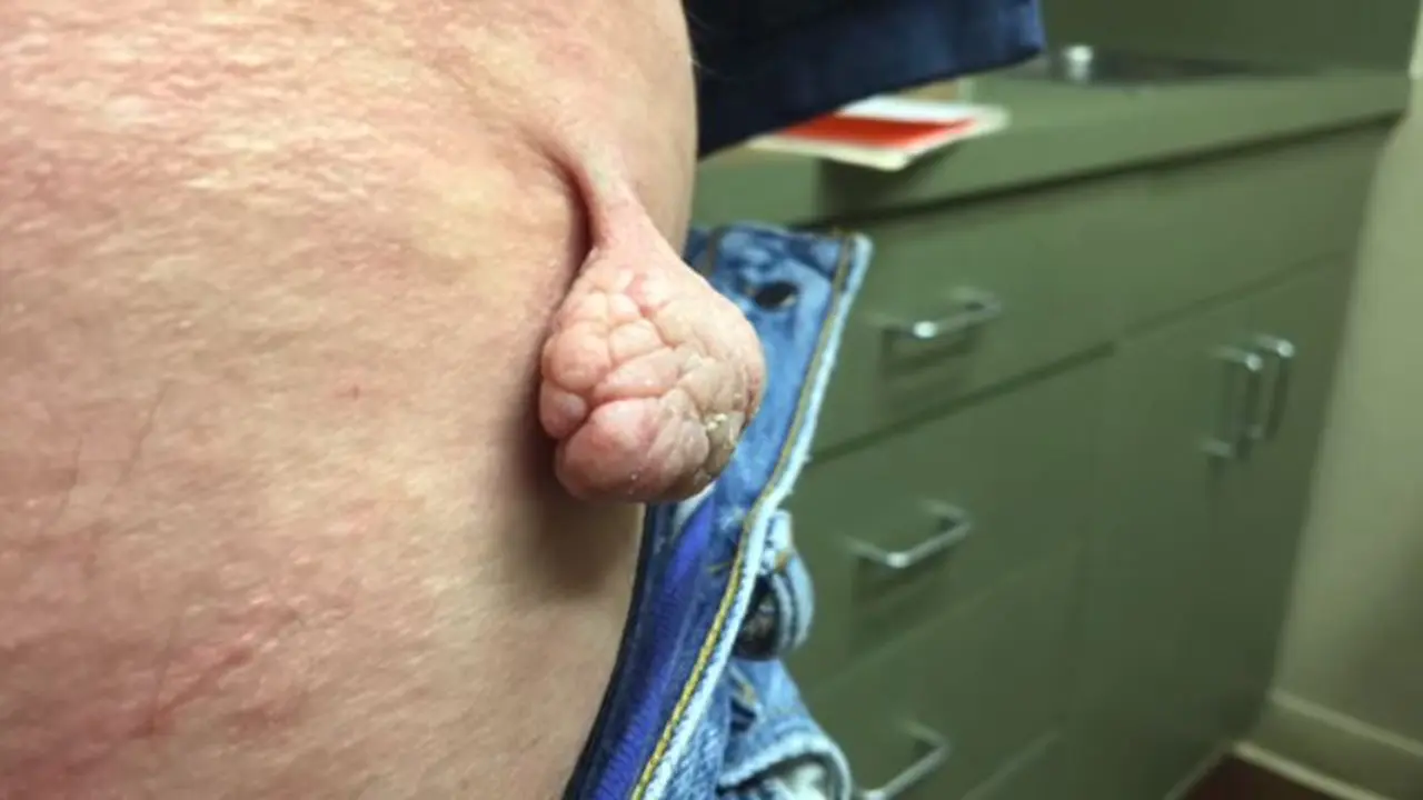 Mirip Otak, Daging Tumbuh Pada Pria Ini Akhirnya Dioperasi