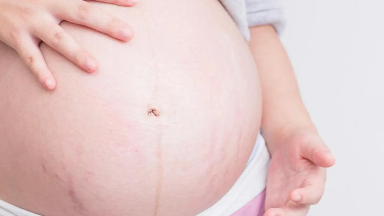 Cara Mudah Cegah Stretch Mark Saat Hamil
