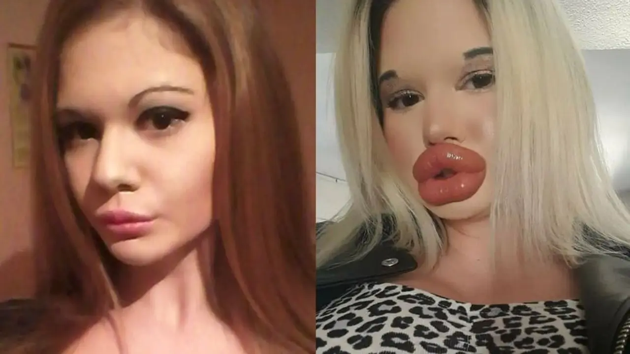 Ivanova wanita Bulgaria kecanduan operasi plastik