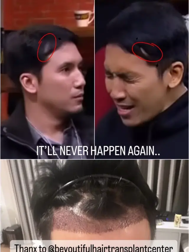 Desta Transplantasi Rambut