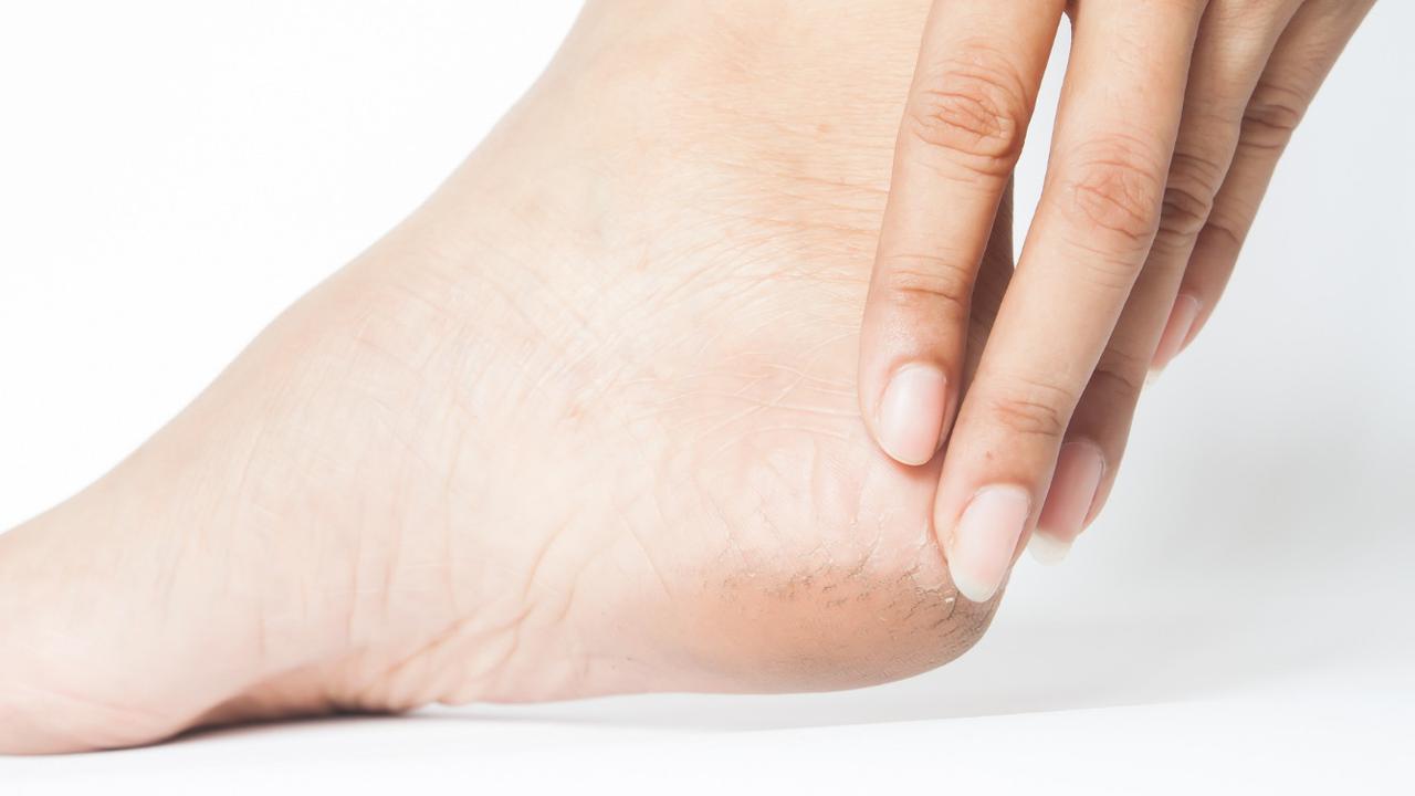 Cara Aman Atasi Kulit Kaki Mengelupas, Hindari Langkah Berbahaya Ini yang Bikin Kaki Infeksi