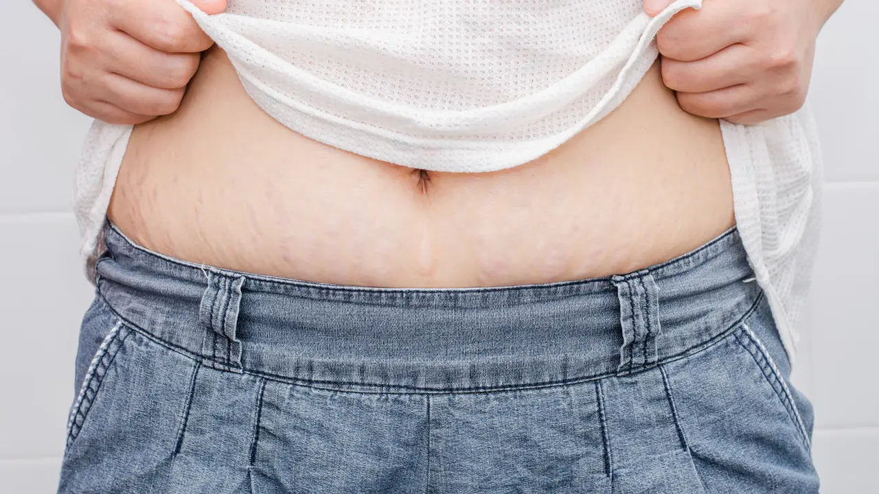 Stretch marks (iStock)