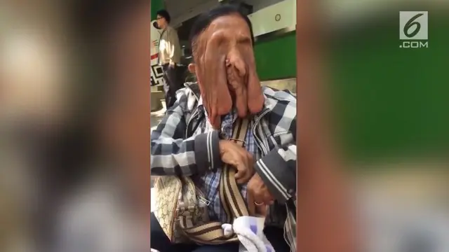 Kulit wajah nenek berusia 63 tahun ini tampak seperti "meleleh". Wiang Boonmeen mengidap penyakit kulit langka.
