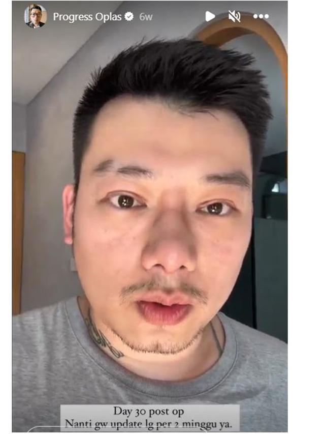 7 Potret Chef William Gozali Jalani Operasi Plastik, Perubahannya Bikin Pangling