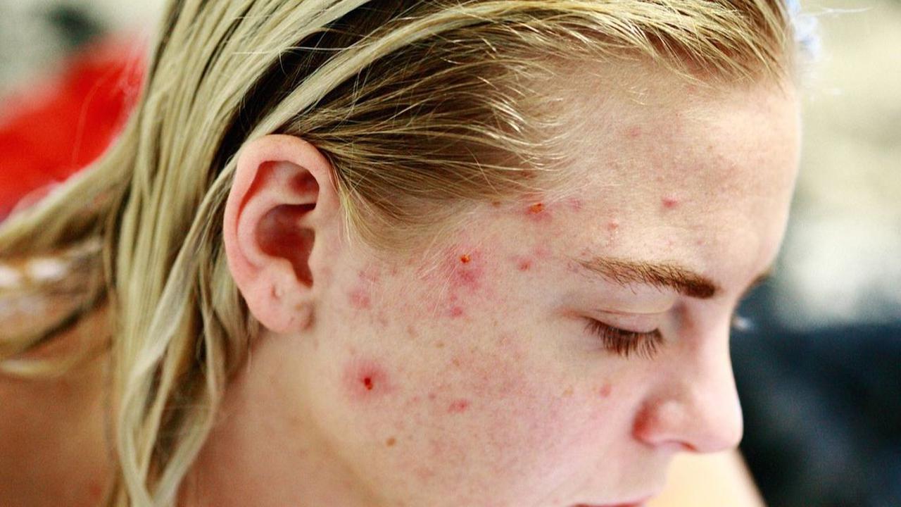 Cara Kerja Acne Patch