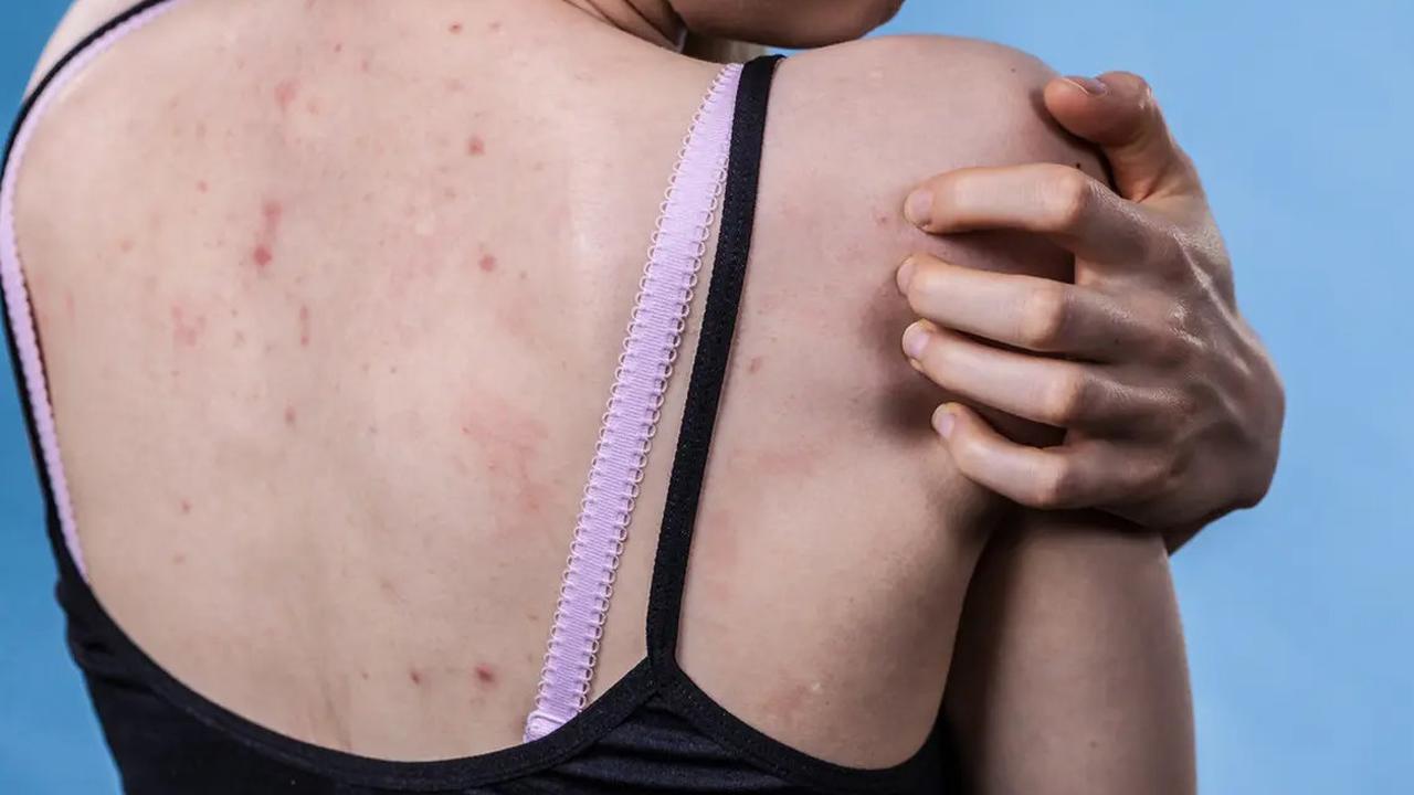 8 Langkah Alami yang Ampuh Atasi Jerawat Punggung, Mulai dari Tea Tree Oil hingga Mengelola Stres