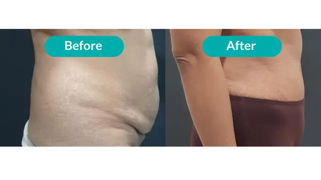 Cerita Shahnaz Haque tentang Liposuction dan Tummy Tuck, Ternyata Nggak Menakutkan Seperti yang Dikira