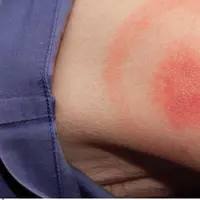 Ruam merah pada kulit seperti cincin. (Via: referensisehat.com)