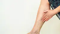 Begini cara punya kaki sehat dan mulus tanpa perlu khawatir varises.