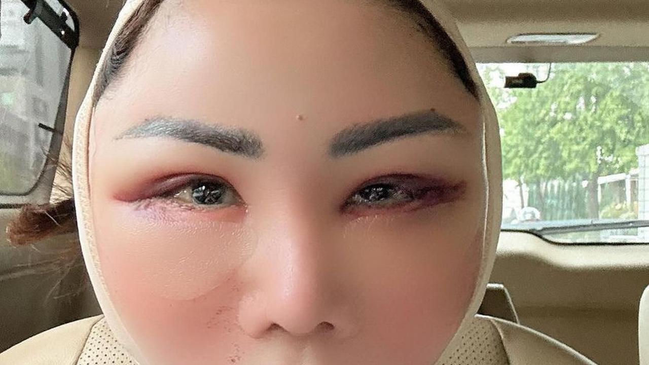 Potret Femmy Permatasari Setelah Oplas di Korea, Rela Wajah Bengkak dan 'Jelek' Dulu Pasca Lakukan 6 Prosedur Operasi
