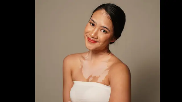 Konsumsi suplemen herbal yang didapat dari MLM, dokter ini kena Vitiligo. Foto: tangkapan layar TikTok @salmakyn.