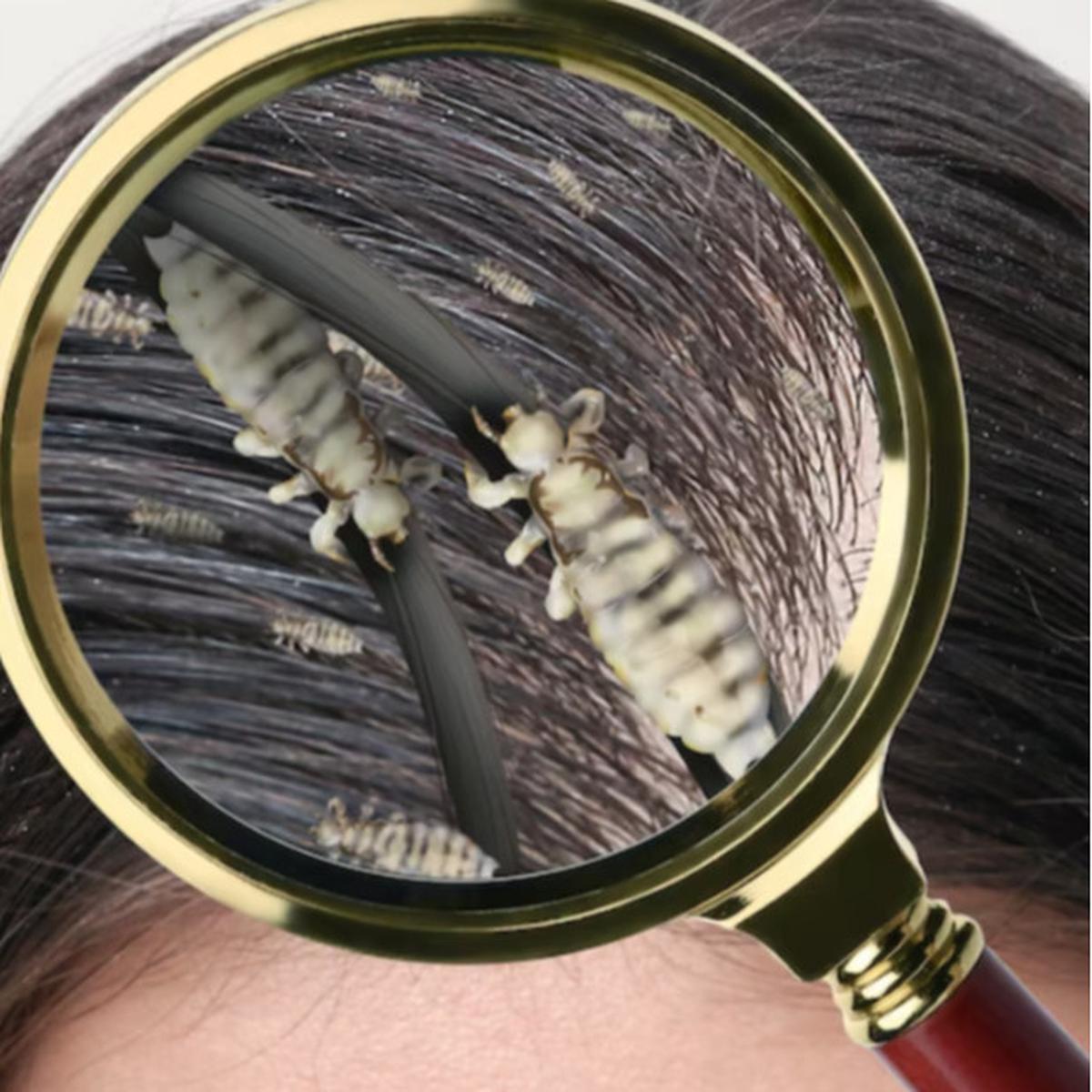 Say Goodbye to Kutu Rambut: Mengatasi Kutu Rambut dalam 5 Langkah