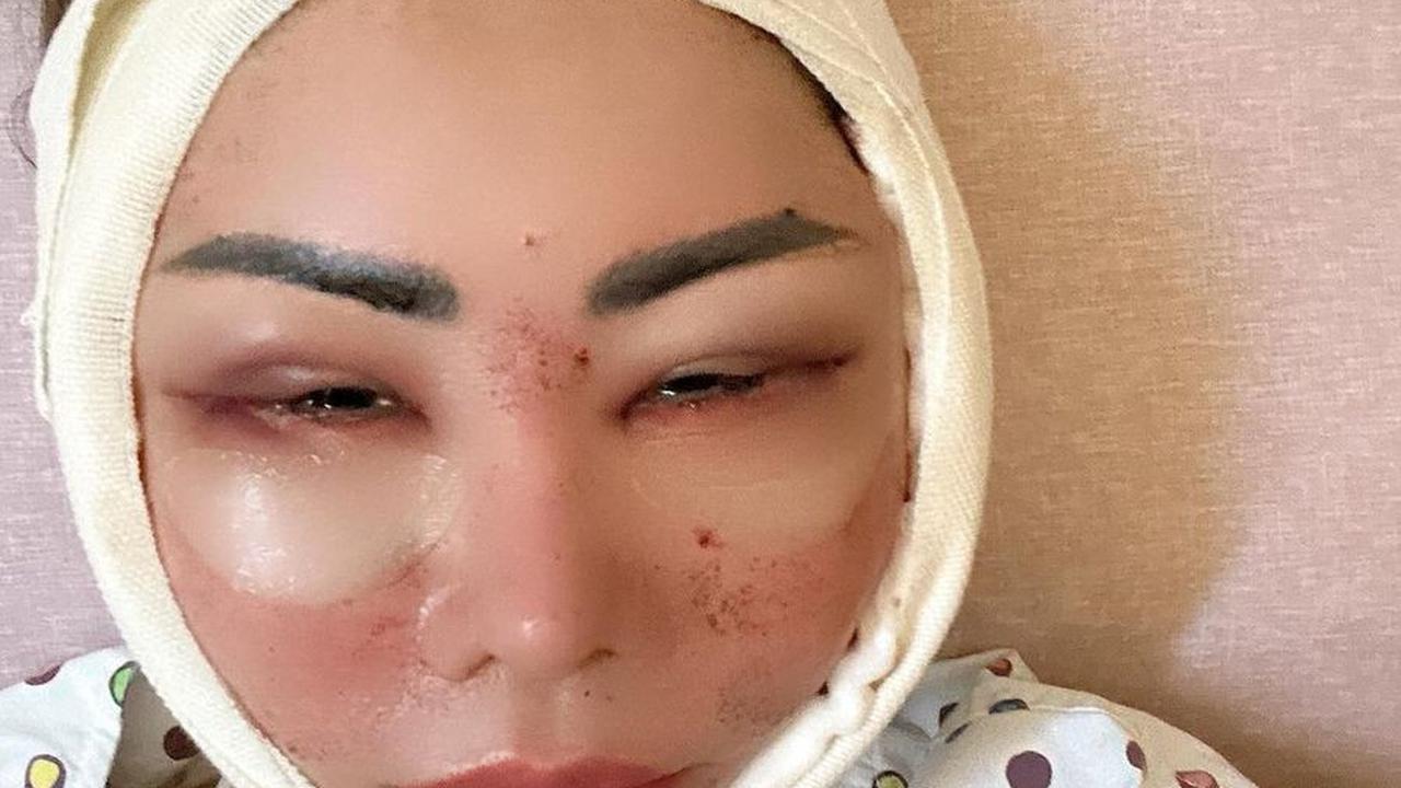 Potret Femmy Permatasari Setelah Oplas di Korea, Rela Wajah Bengkak dan 'Jelek' Dulu Pasca Lakukan 6 Prosedur Operasi