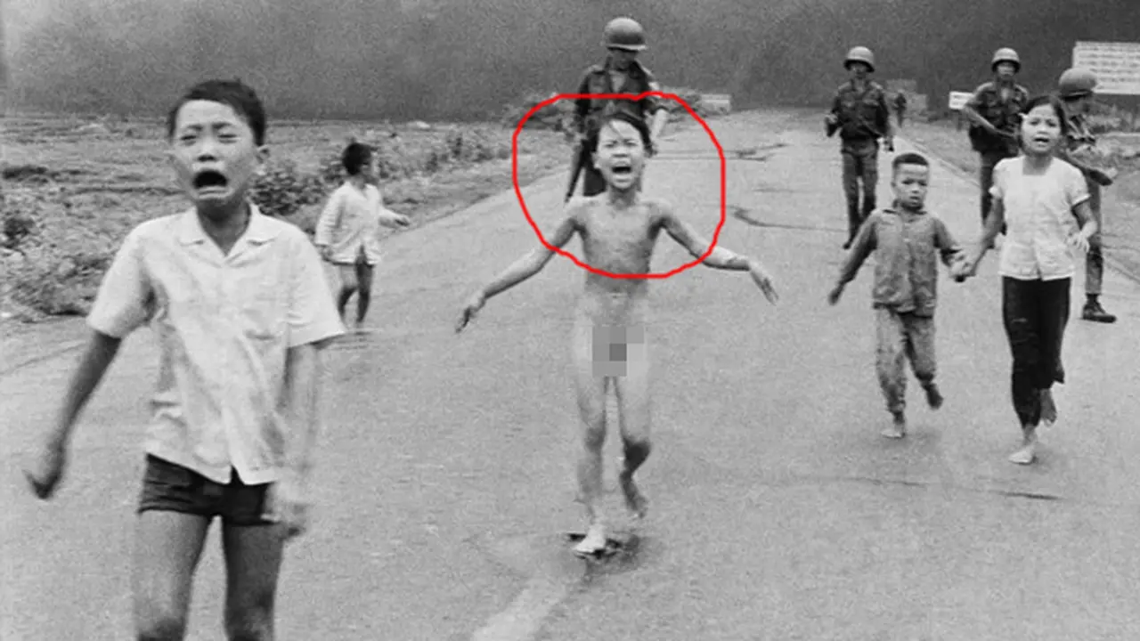 Kini Bocah Korban Bom dalam Foto Ikonik Jalani Penyembuhan