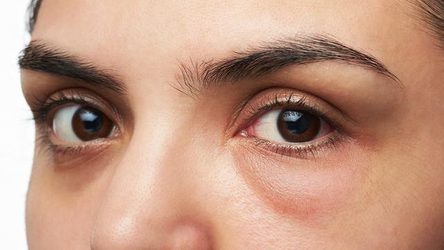 Siapa yang berisiko terkena glaukoma?